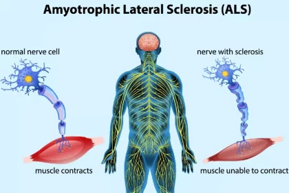 Scientists found a promising gene-therapy to cure ALS