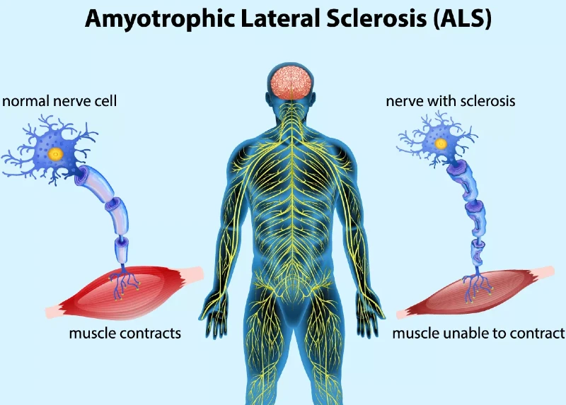 Scientists found a promising gene-therapy to cure ALS
